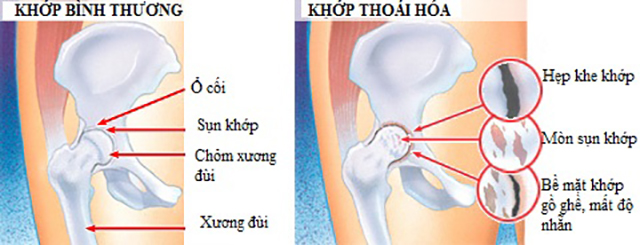 Thực Phẩm Chức Năng Hỗ Trợ Sụn Khớp Và Ngăn Ngừa Thoái Hóa Khớp Omexxel Arthri (Hộp 30 Viên)
